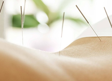 Szkolenie SUCHE IGŁOWANIE (Dry needling) w ujęciu klinicznym - dla fizjoterapeutów i lekarzy